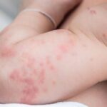 Kenali Tanda Anak Alergi Susu Sapi, Mom di Rumah Wajib Tahu